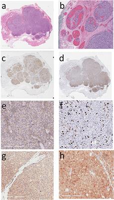 Intrathyroidal Parathyroid Carcinoma: An Atypical Thyroid Lesion